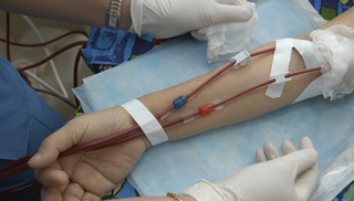 fistula for dialysis placement