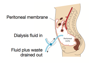 Peritoneal Dialysis Diagram