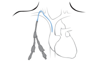 Vascular Access for Hemodialysis