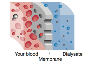 How does peritoneal dialysis work? - Chronic Kidney Disease Explained