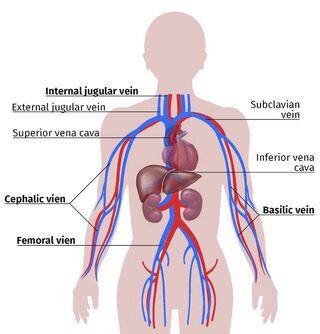 fistula for dialysis placement